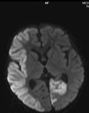 <b>Figure 2:</b> Diffusion- weighted MRI shows diffusion restriction along the right MCA territory and left occipital lobe.